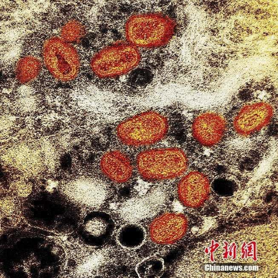 当地时间2022年7月26日，美国马里兰州，在实验室培养的感染细胞(棕色)中发现的猴痘颗粒(橙色)的彩色透射电子显微图。.png
